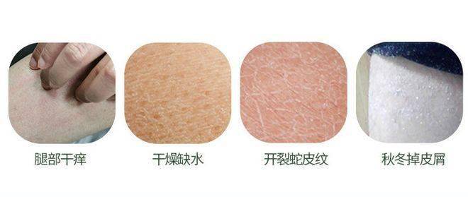 季节性皮肤干燥，成因、影响与应对策略