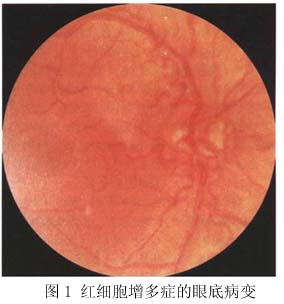 红细胞增多症眼底病变研究