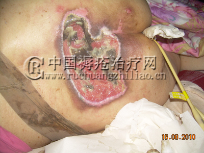 褥疮治疗的有效方法与策略