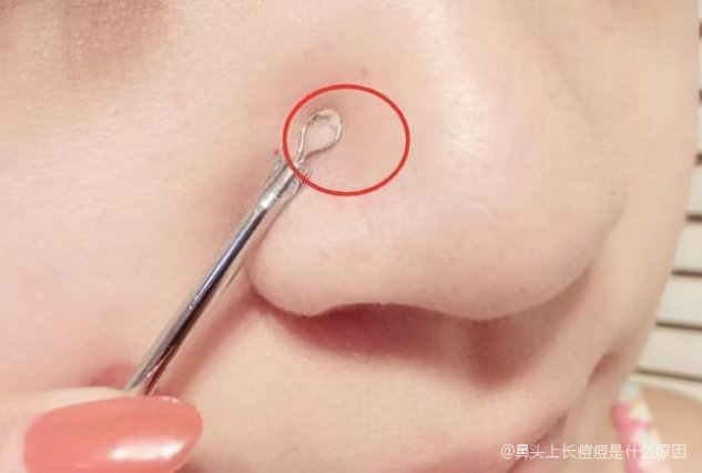 鼻子上长了个大痘痘怎么办，成因解析与应对之策