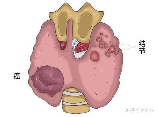 甲状腺结节金银花疗效研究