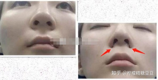面对鼻子大怎么办，探索解决方案与自信重塑