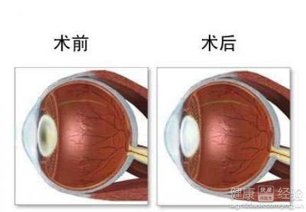 白内障术后戴眼罩的作用及其重要性