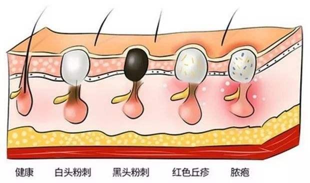 鼻子上长脓包型痘痘，成因、预防与治疗方法