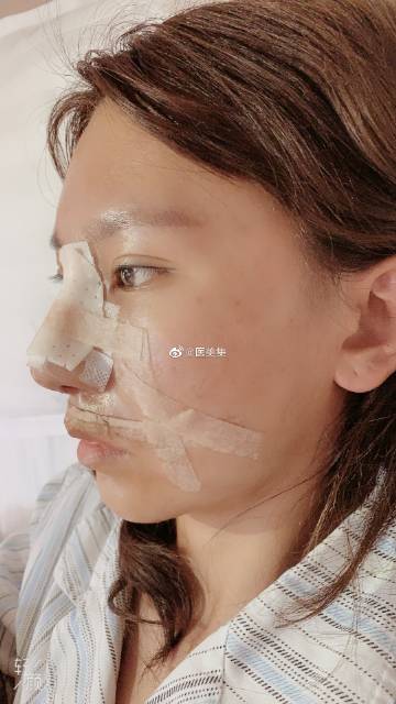 重塑美丽，整容鼻子的探索之旅