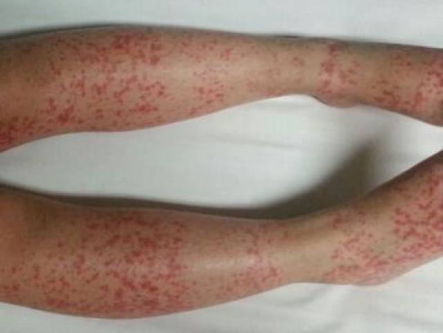 儿童紫癜肾炎专家，守护幼小心灵的守护者