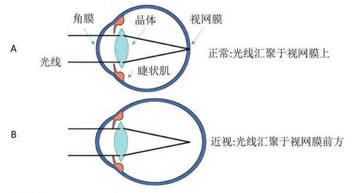 真假性近视测试，如何准确判断近视类型与应对方法