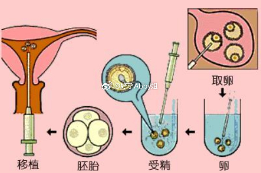 取卵后何时可移植，时间与恢复的双重考量