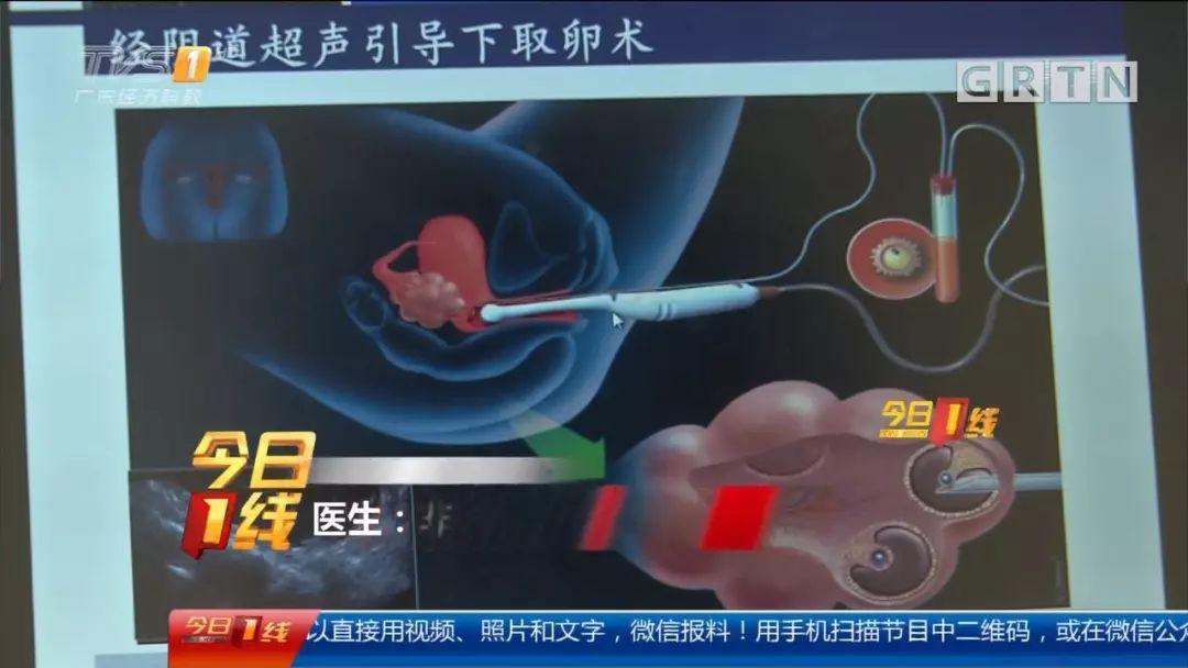 取卵胚胎，现代医学的奇迹与人类生殖的探索