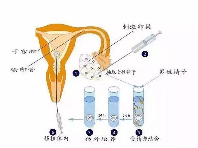 试管婴儿过程中取卵时的疼痛感受解析