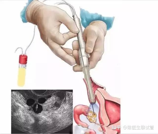 取卵长方案，辅助生殖技术的细致解析