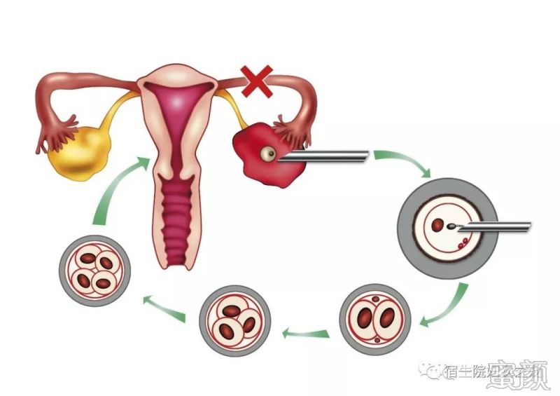 取卵后推迟一个月，理解背后的原因与应对之策